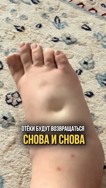 Ты никогда не уберешь отеки