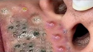 Выдавливание прыщей. НОВОЕ! Угри. Акне. чистка лица.