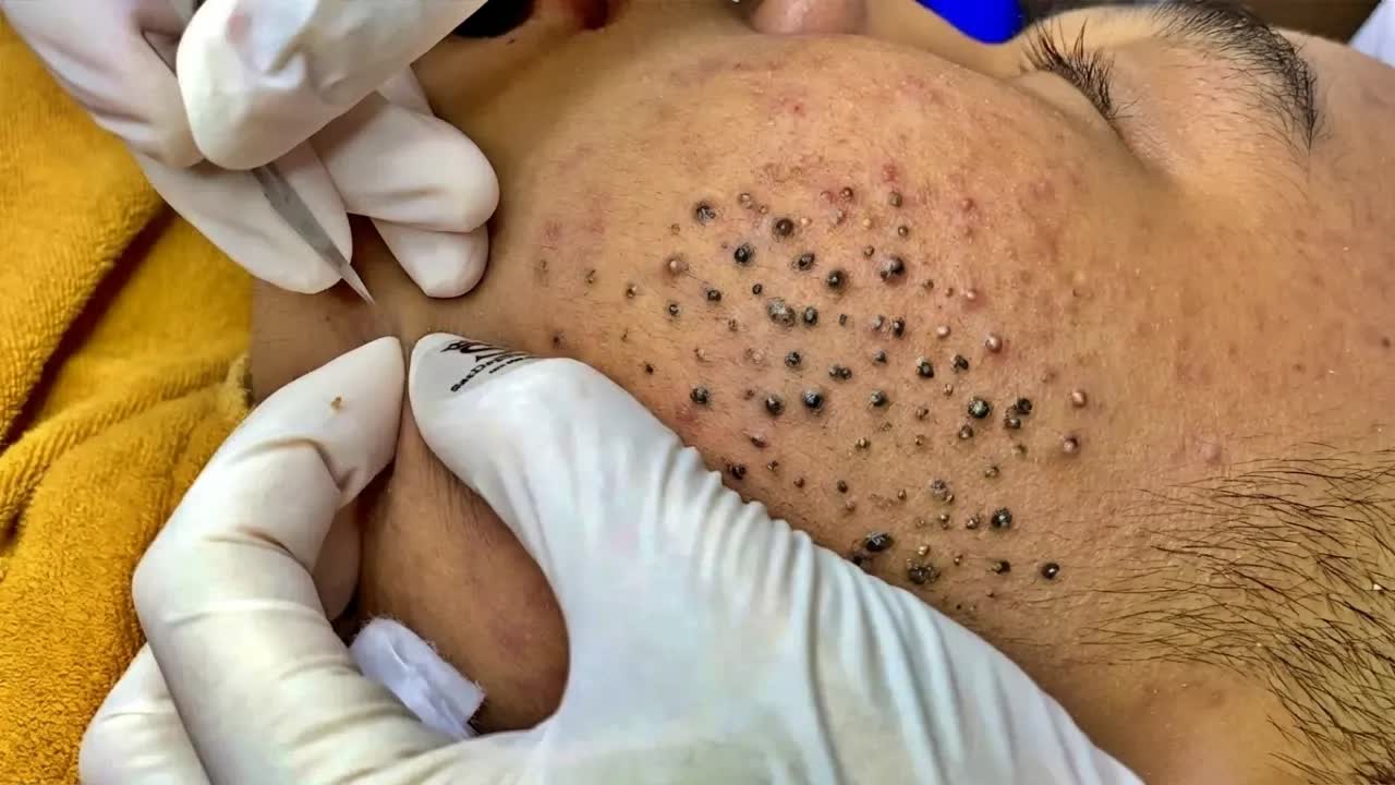 Удаление чёрных точек в спа-салоне Sac Dep