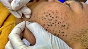 Удаление чёрных точек в спа-салоне Sac Dep