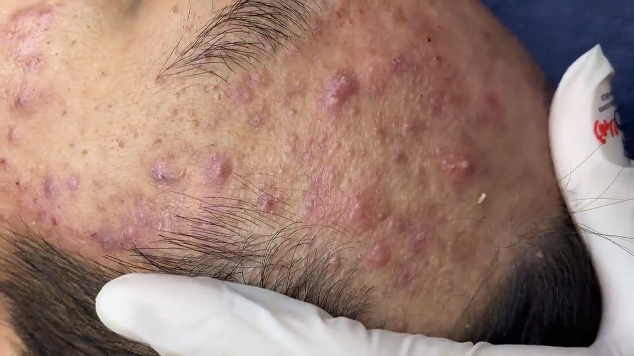 441 • Acne Collection • АСМР • Relax Spa