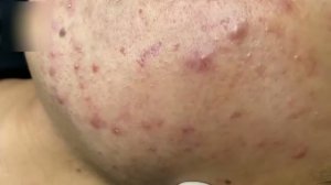 Удаление прыщей и комедонов – профессионально
