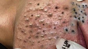 Выдавливание прыщей. «слабонервным не смотреть»