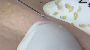 Лечение акне Лоан Нгуен
