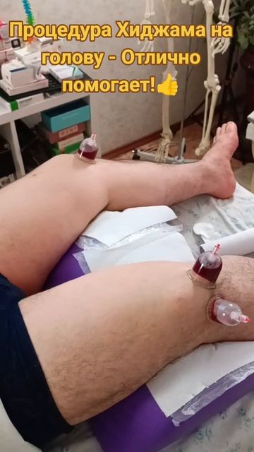 Процедура Хиджама на голову - Отлично помогает от проблем психических, когнитивных и от облысения!👍