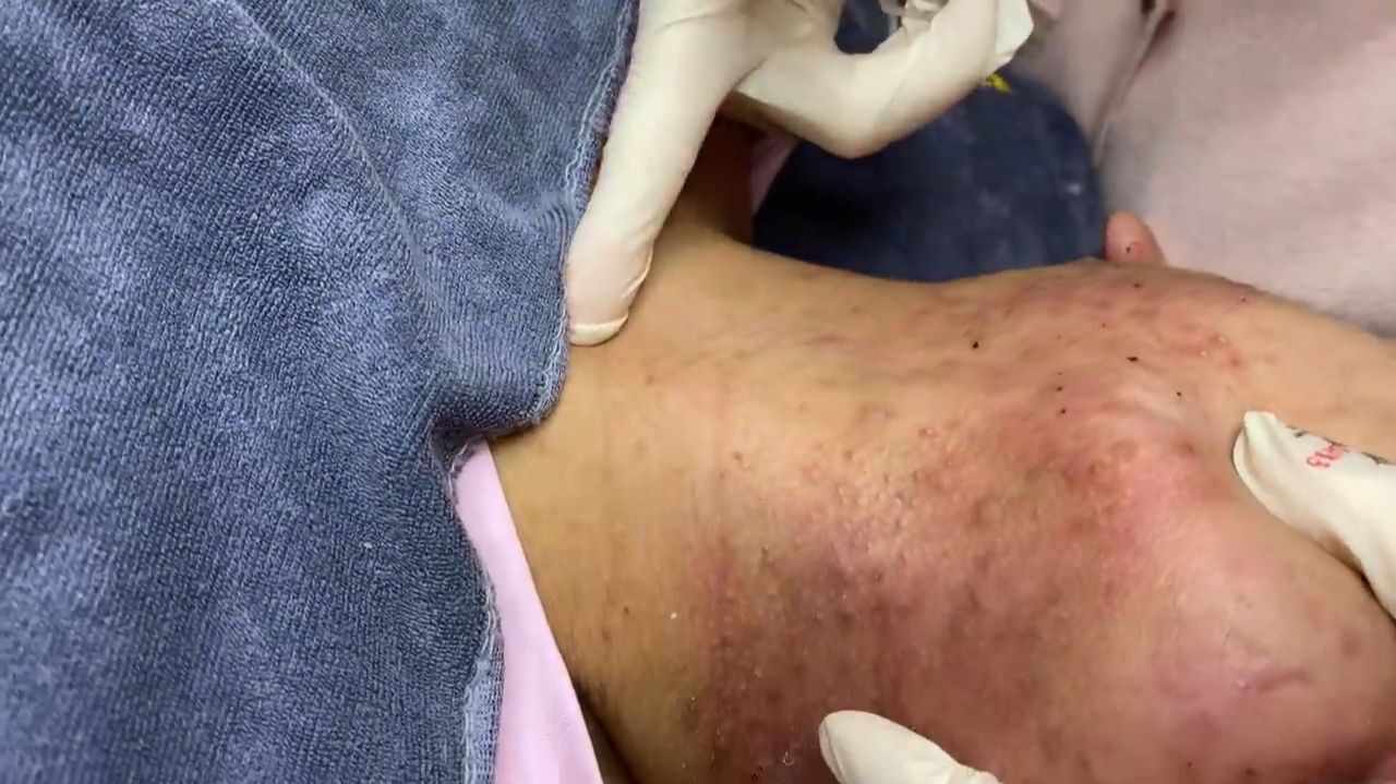 436 • Acne Collection • АСМР • Relax Spa