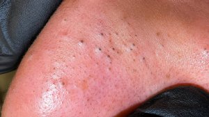 Глубокое очищение пор — чёрные точки | Корейский уход за кожей