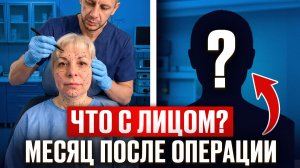 ЧЕСТНЫЙ результат спустя 3 месяца! Полная подтяжка лица в Дубае: нижняя треть, шея и глаза!