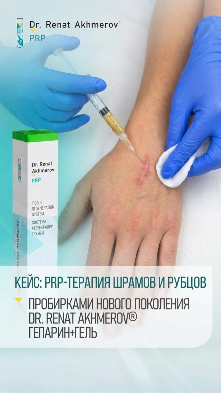 ПЛАЗМОТЕРАПИЯ ШРАМОВ И РУБЦОВ.
