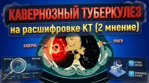 Инфильтративно-КАВЕРНОЗНЫЙ ТУБЕРКУЛЕЗ легких и ЛИМФАДЕНОПАТИЯ СРЕДОСТЕНИЯ на РАСШИФРОВКЕ КТ легких