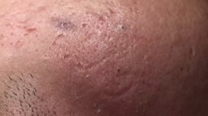 Множественные прыщи – удаление и чистка