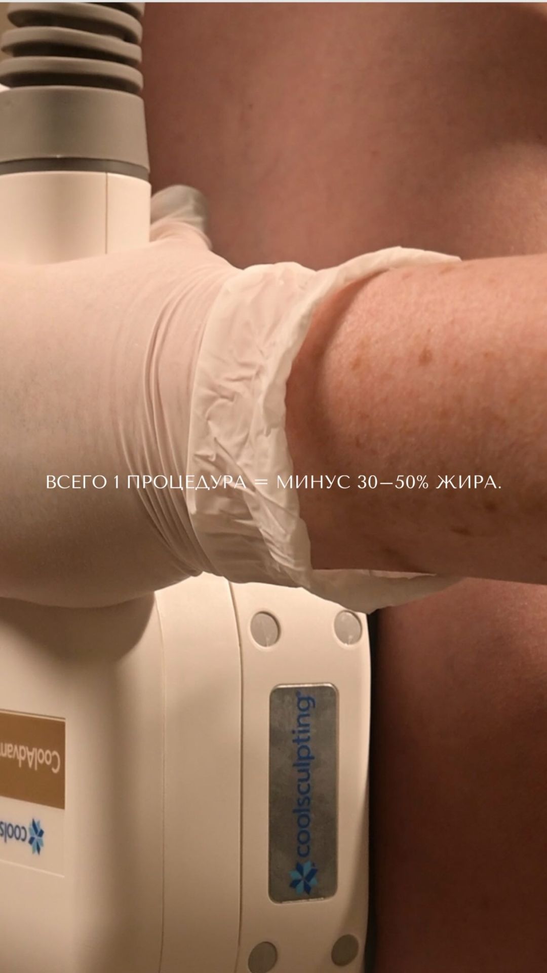  ВСЕГО 1 ПРОЦЕДУРА  МИНУС 3050 ЖИРА.