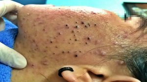 Удаление чёрных точек в спа-салоне Sac Dep