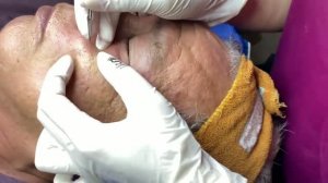 Возрастные комедоны – удаление черных точек у пожилой клиентки