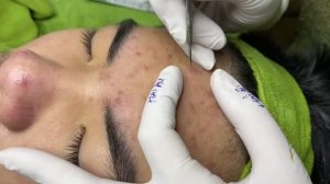 Чистка лица – удаление прыщей без последствий