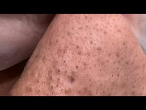 Идеальный уход за лицом: удаление чёрных точек и решение проблем кожи
