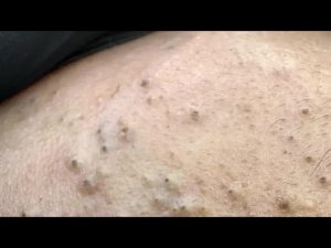 Глубокое очищение пор от прыщей и черных точек - [ASMR] Уход за лицом и средства