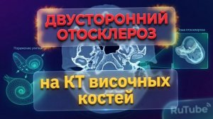 Признаки ОТОСКЛЕРОЗА на КТ и склеротических изменений сосцевидного отростка на расшифровке КТ