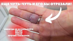 Как снять кольцо с отекшего пальца, если оно не снимается и палец опух?