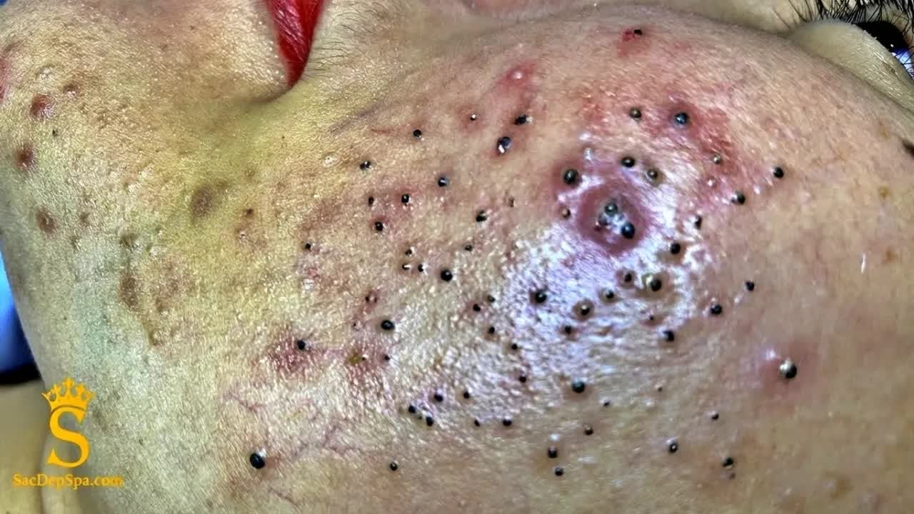 Удаление черных точек с Sac Dep Spa