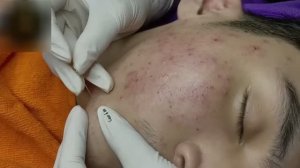 #948 Удаление акне. Экстракция комедонов. Подкожные прыщи. Чистка от черных точек