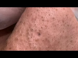 Глубокое удаление черных точек [4K]: техники для чистой кожи!
