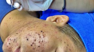 Удаление черных точек в спа-салоне Sac Dep