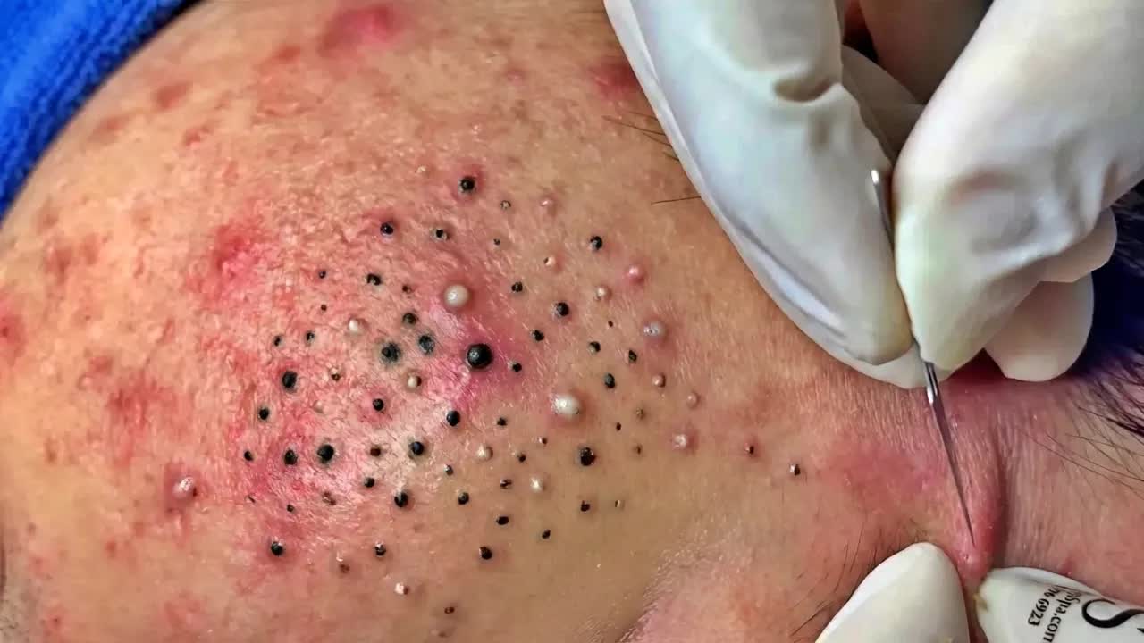 Удаление черных точек с Sac Dep Spa