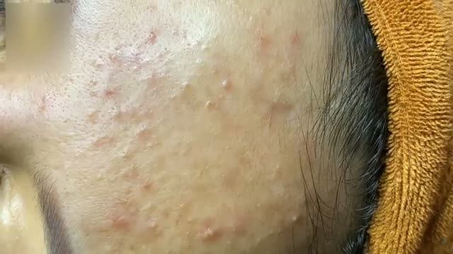 Удаление акне – результат виден сразу