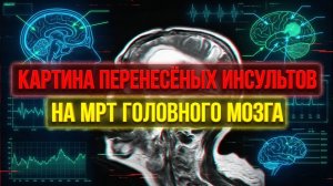 РАЗРУШЕНИЕ МОЗГА МЕТАСТАЗ в голове с ОТЕКОМ ПОСЛЕ ИНСУЛЬТОВ на МРТ головного мозга после РАСШИФРОВКИ
