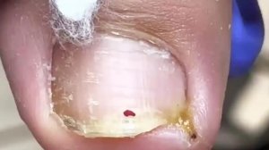 Серьёзный паронихий и вросший ноготь: лечение у доктора Лю【Подология】