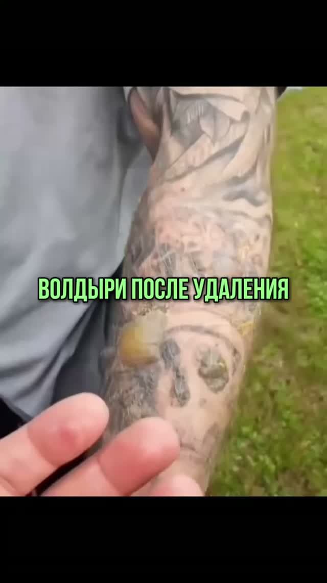 ВОЛДЫРИ ПОСЛЕ УДАЛЕНИЯ
