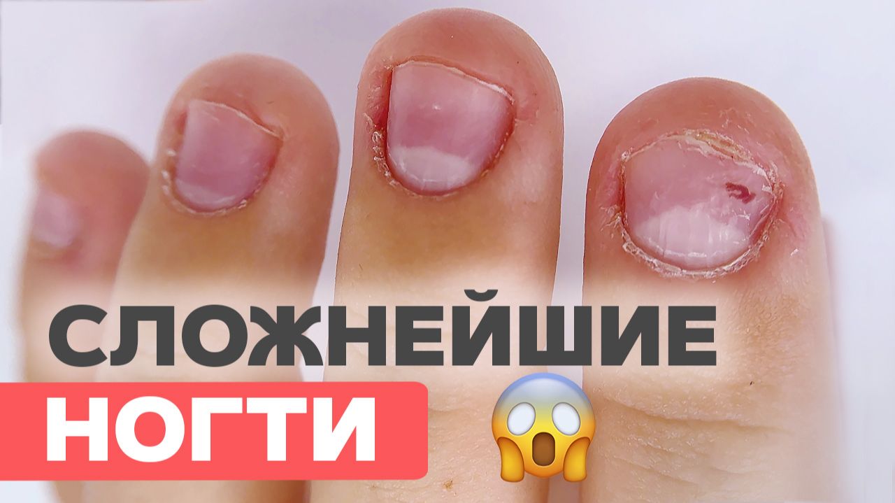 Как восстановить обгрызенные ногти? Способ отрастить натуральную длину