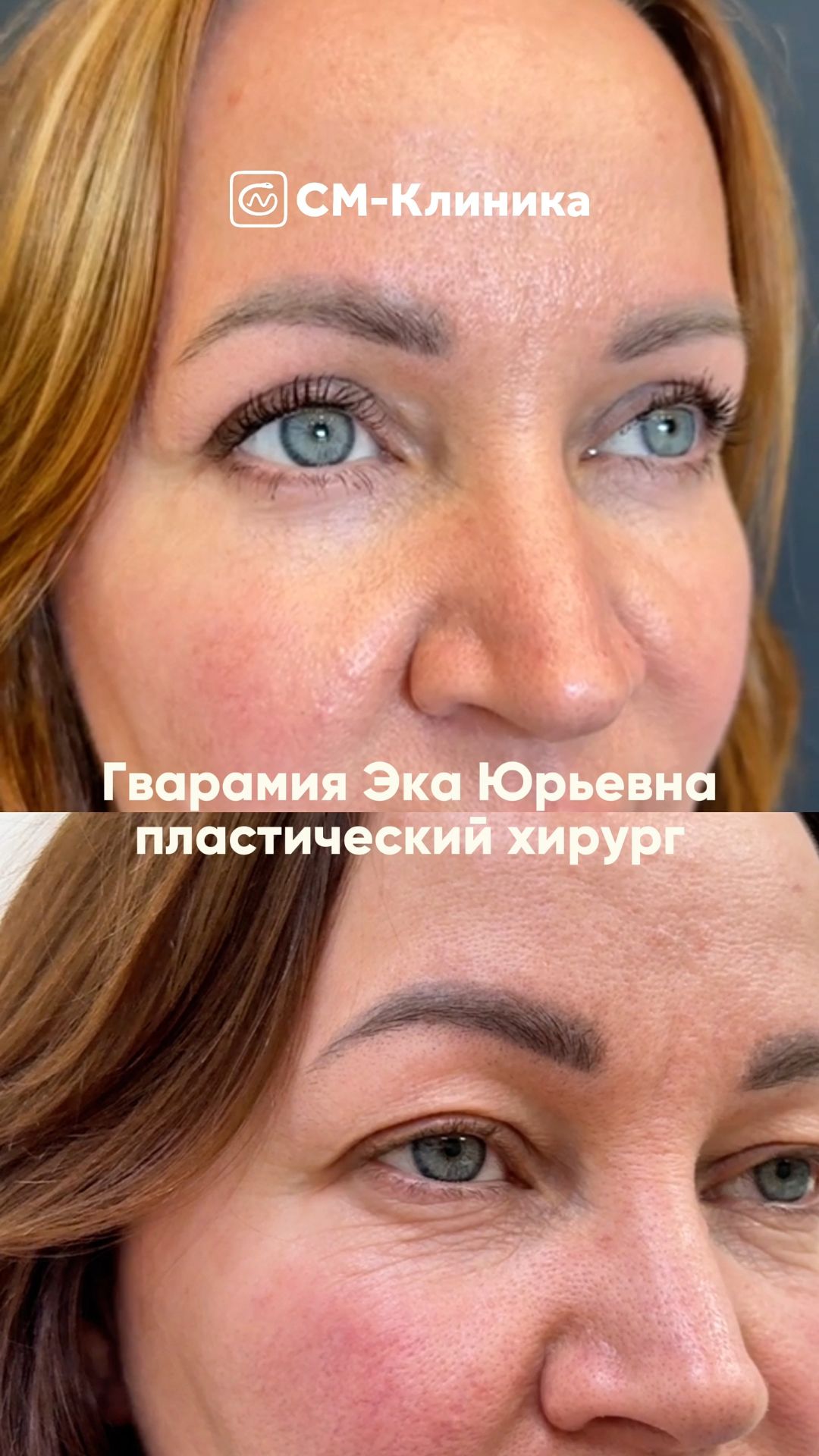 Круговая блефаропластика в «СМ-Клиника» 💚