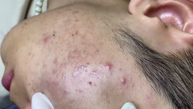 Чистка лица – удаление чёрных точек и прыщей