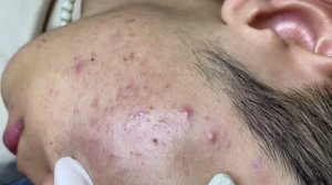 Чистка лица – удаление чёрных точек и прыщей