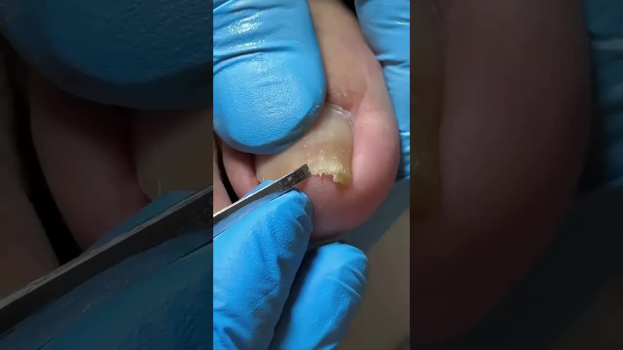 Вросшие ногти аккуратно подстрижены ✂️