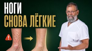 Варикоз, отёки и боль в ногах: копеечный рецепт скорой помощи