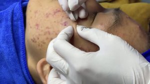 Чистка лица – избавление от угревой сыпи