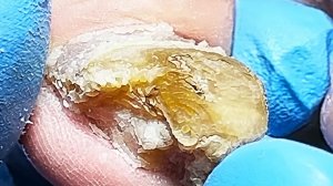 Невероятное преображение сильно утолщённых ногтей【Король педикюра】