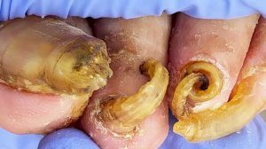 Полное удаление старого толстого ногтя【Pedicure King】