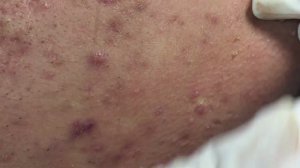 Чистка лица – удаление акне и комедонов