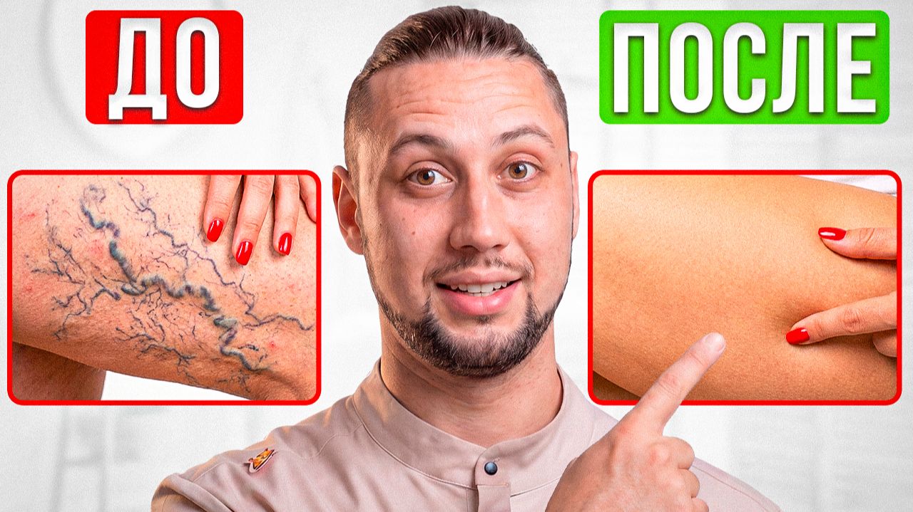 Сосудистые сеточки на ногах УЙДУТ СРАЗУ! За 10 минут в домашних условиях