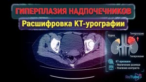 КАМНИ В ПОЧКАХ гиперплазия надпочечника МОЧЕКАМЕННАЯ БОЛЕЗНЬ нефролитиаз на РАСШИФРОВКЕ КТ урографии