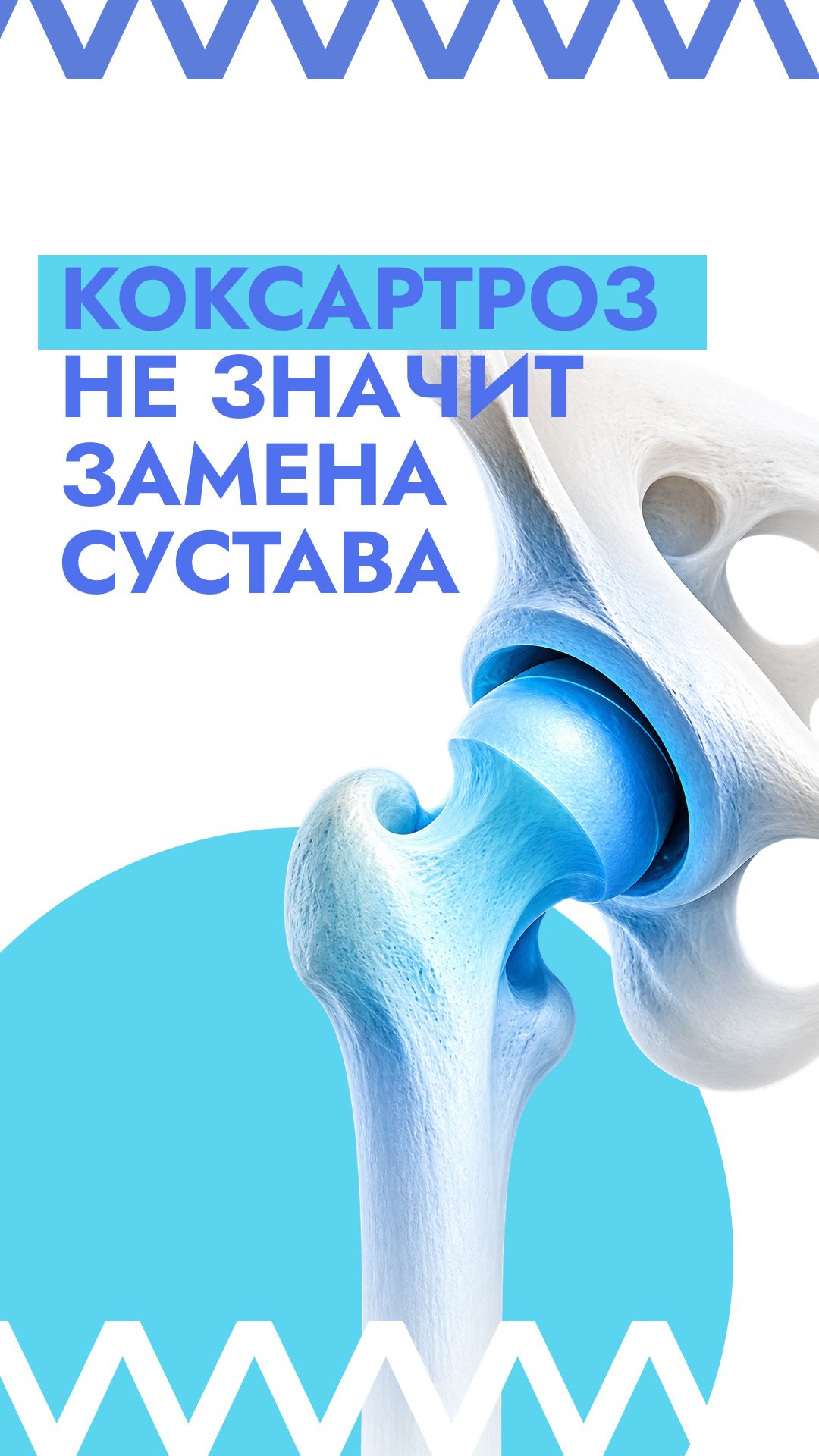 Коксартроз - не значит замена сустава