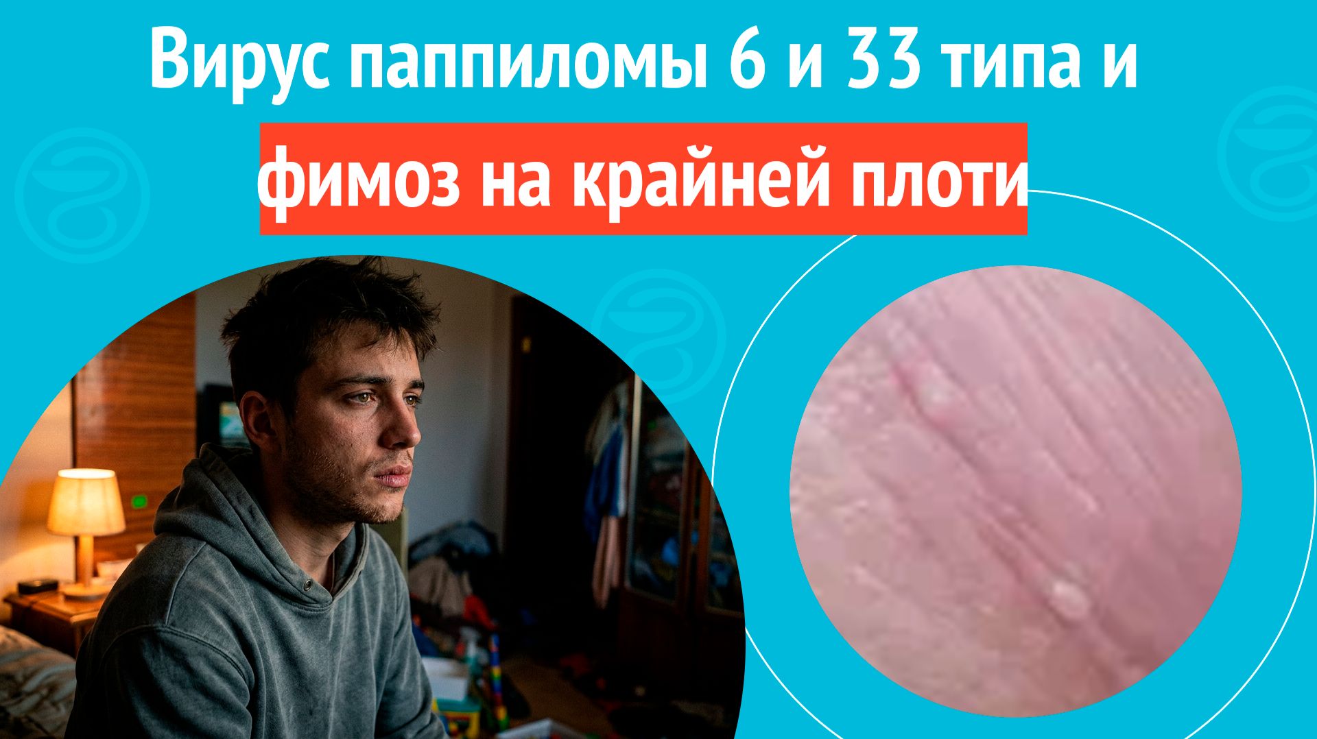  Вирус папилломы 6 и 33 типа и фимоз на крайней плоти. Клинический случай  1836