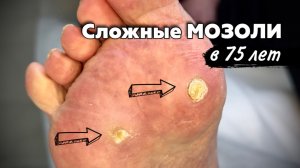 Сухие мозоли на стопе