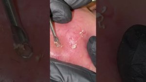 Эти черные точки прятались под кожей...