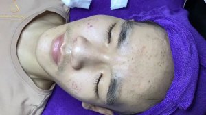 Лечение акне от Лоан Нгуен