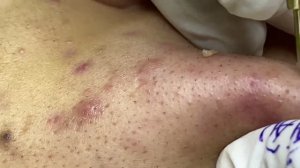 Удаление акне – стойкий эффект